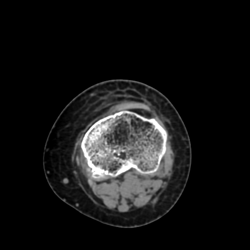 File:Chondrosarcoma - femur (Radiopaedia 64187-72954 Axial non-contrast 65).jpg
