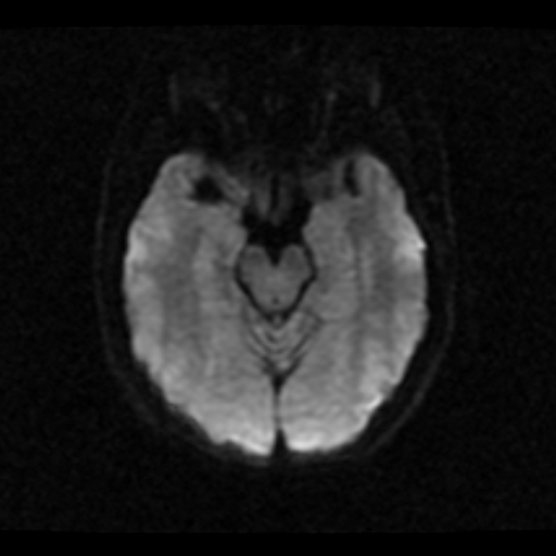 File:Choroid plexus xanthogranuloma (Radiopaedia 17650-17386 DWI 15).jpg