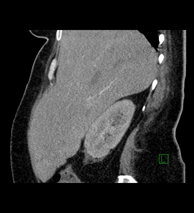 Chromophobe renal cell carcinoma (Radiopaedia 84239-99519 D 89).jpg