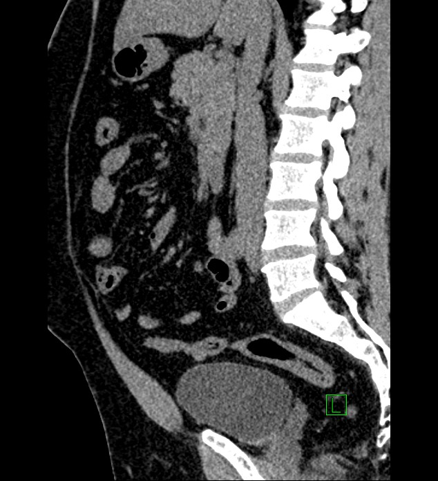 Chromophobe renal cell carcinoma (Radiopaedia 84286-99573 C 97).jpg