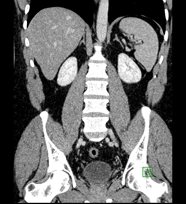 Chromophobe renal cell carcinoma (Radiopaedia 84286-99573 H 116).jpg