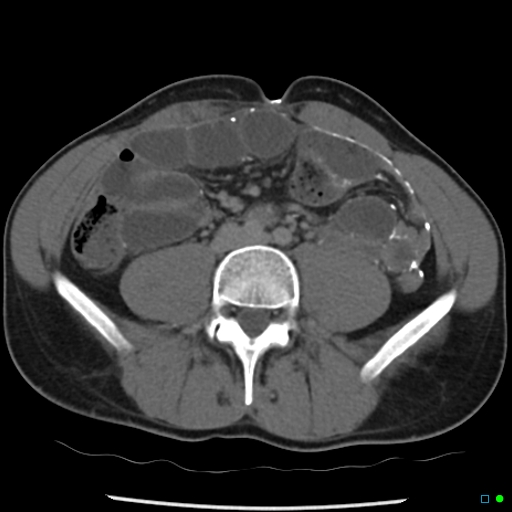 File:Chronic barium peritonitis and small bowel obstruction (Radiopaedia 29151-29548 D 9).jpg
