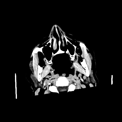 Chronic bilateral subdural hygroma (Radiopaedia 85801-101622 Axial non-contrast 13).jpg