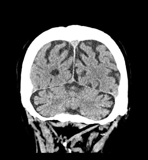Chronic bilateral subdural hygroma (Radiopaedia 85801-101623 B 19).jpg