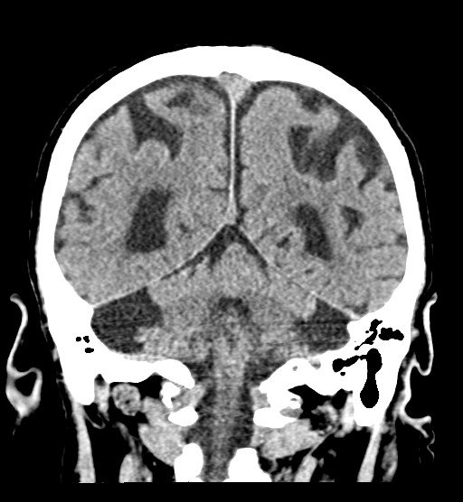 Chronic bilateral subdural hygroma (Radiopaedia 85801-101623 B 26).jpg