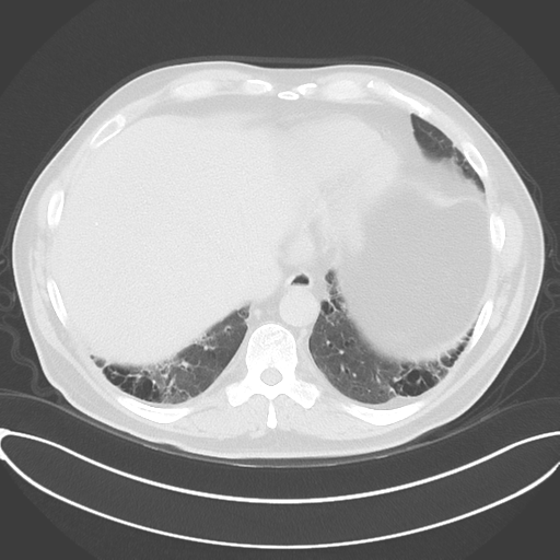 File:Chronic hypersensitivity pneumonitis (Radiopaedia 48107-52922 Axial lung window 48).png