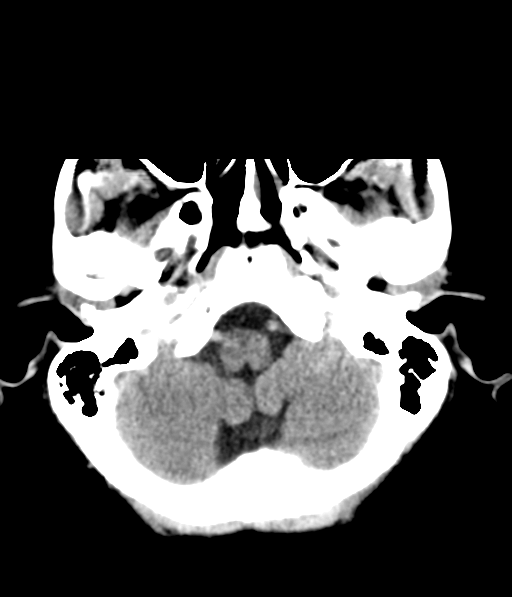File:Chronic hypertensive encephalopathy (Radiopaedia 39993-42485 Axial non-contrast 7).png