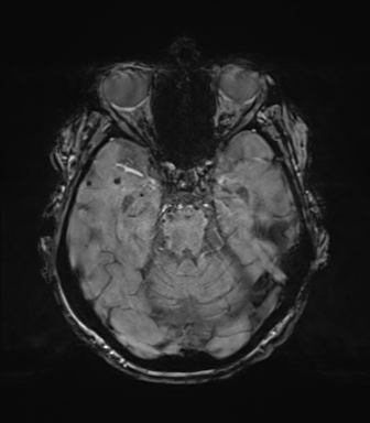 Chronic hypertensive encephalopathy (Radiopaedia 72844-83495 Axial SWI magnitude 28).png