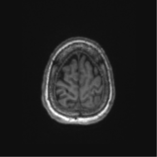 Chronic hypertensive encephalopathy (Radiopaedia 72844-83495 Axial T1 10).png