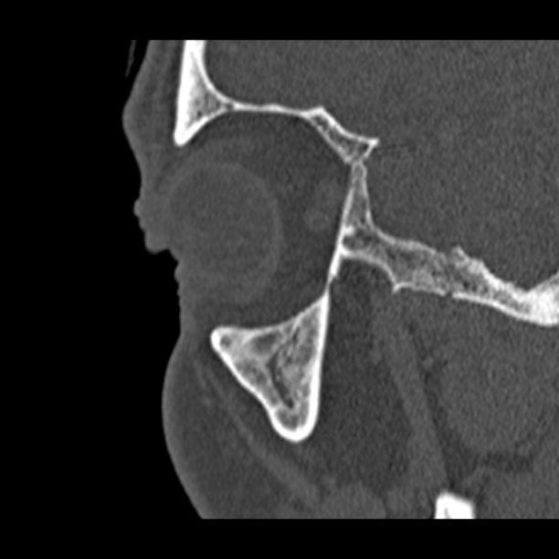 Chronic maxillary sinusitis (Radiopaedia 27879-28116 Sagittal bone window 52).jpg