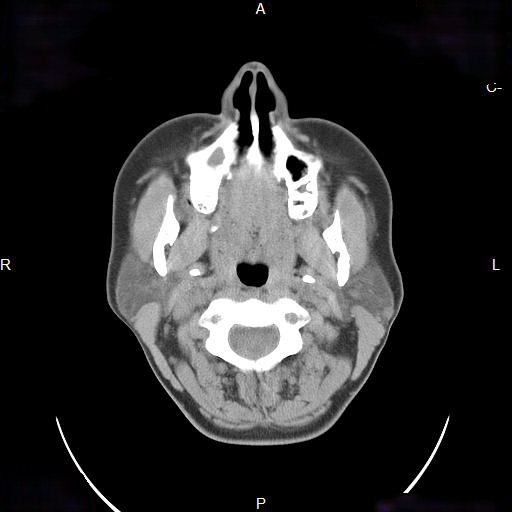 File:Chronic maxillary sinusitis with a foreign body (dental filling material) (Radiopaedia 7811-8639 Axial non-contrast 1).jpg