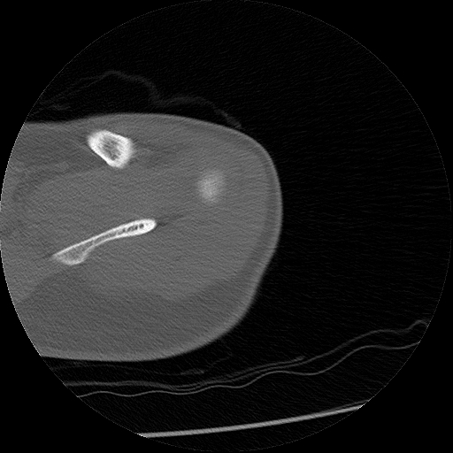 File:Chronic osteomyelitis (Radiopaedia 67597-76998 Axial bone window 3).jpg