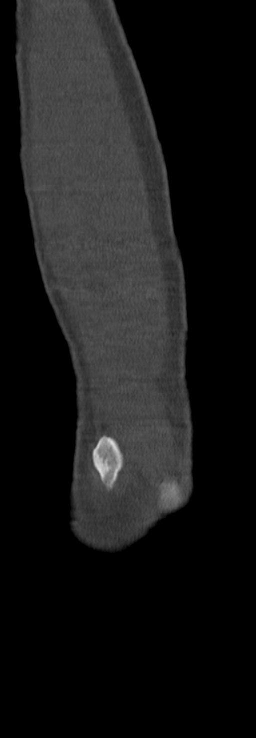 Chronic osteomyelitis of the distal humerus (Radiopaedia 78351-90971 Sagittal bone window 65).jpg