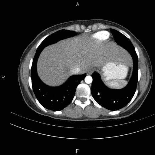 File:Chronic pancreatitis (Radiopaedia 64576-73450 B 6).jpg