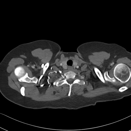 File:Chronic pulmonary embolus (Radiopaedia 39129-41341 Axial C+ CTPA 7).png