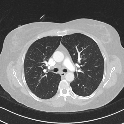 Chronic pulmonary embolus (Radiopaedia 39129-41341 Axial lung window 26).png