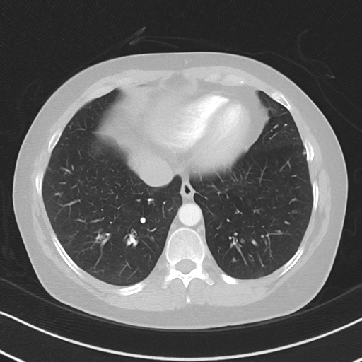 Chronic pulmonary embolus (Radiopaedia 39129-41341 Axial lung window 47).png