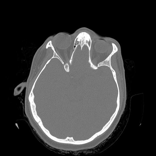 Chronic sinusitis with intra-sinus calcification (Radiopaedia 63919-72668 Axial bone window 2).jpg