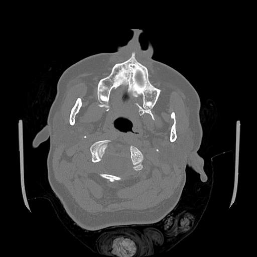 Chronic sinusitis with intra-sinus calcification (Radiopaedia 63919-72668 Axial bone window 81).jpg