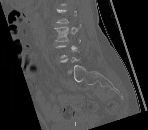 File:Chronic spinal hematoma with cauda equina syndrome (Radiopaedia 75745-88197 Sagittal bone window 23).png