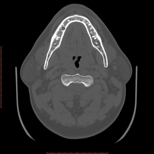Chronic submandibular sialolithiasis (Radiopaedia 69817-79814 Axial bone window 53).jpg