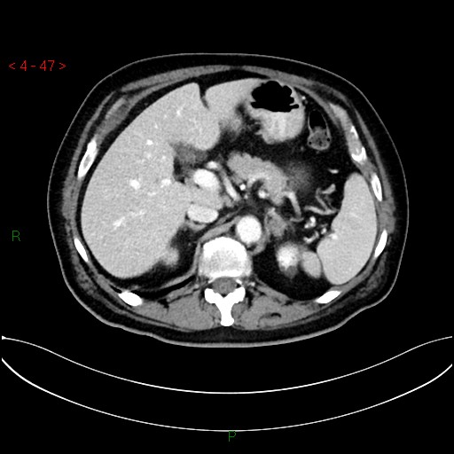 File:Circumaortic left renal vein and doubled left renal arteries (Radiopaedia 52268-58158 B 7).jpg