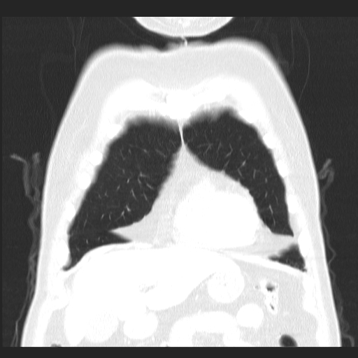 File:Classic complicated silicosis (Radiopaedia 49720-54961 Coronal lung window 9).jpg