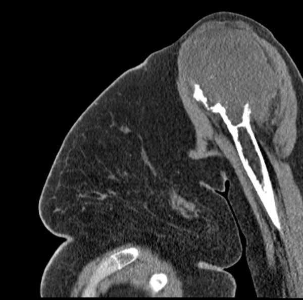 File:Clear cell chondrosarcoma - humerus (Radiopaedia 63104-71612 D 20).jpg