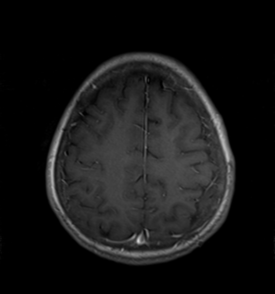 File:Clival meningioma (Radiopaedia 53278-59248 Axial T1 C+ 19).jpg