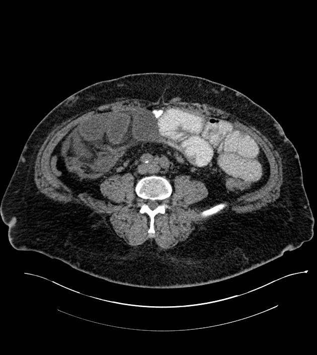 Closed-loop small bowel obstruction-internal hernia (Radiopaedia 78439-91096 Axial non-contrast 98).jpg
