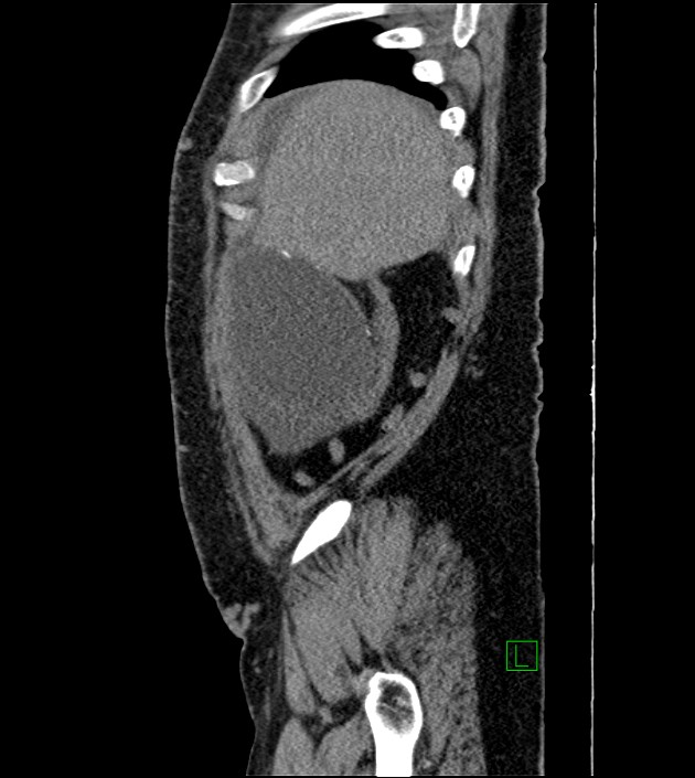 Closed-loop small bowel obstruction-internal hernia (Radiopaedia 78439-91096 C 123).jpg