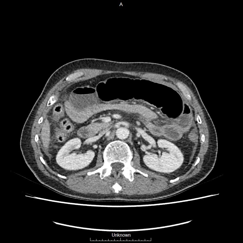 Closed loop bowel obstruction and ischemia (Radiopaedia 86959-103180 A 27).jpg