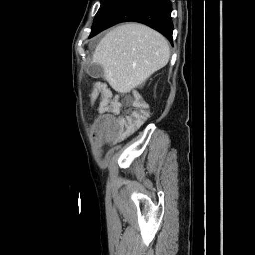 File:Closed loop obstruction due to adhesive band, resulting in small bowel ischemia and resection (Radiopaedia 83835-99023 F 43).jpg