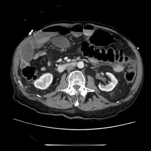 File:Closed loop small bowel obstruction - adhesive disease and hemorrhagic ischemia (Radiopaedia 86831-102990 A 92).jpg