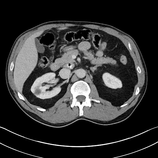 Closed loop small bowel obstruction - internal hernia (Radiopaedia 57806-64778 B 43).jpg
