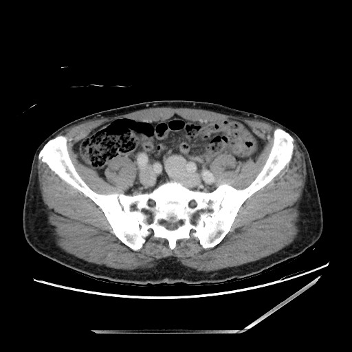 Closed loop small bowel obstruction - omental adhesion causing "internal hernia" (Radiopaedia 85129-100682 A 125).jpg