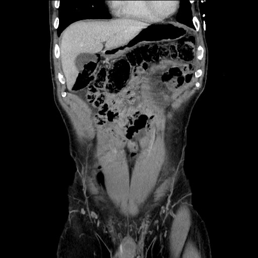 File:Closed loop small bowel obstruction - omental adhesion causing "internal hernia" (Radiopaedia 85129-100682 B 38).jpg
