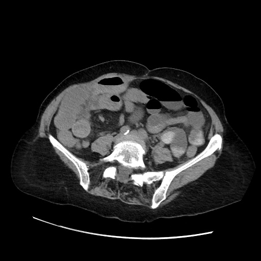 Closed loop small bowel obstruction due to adhesive band, with intramural hemorrhage and ischemia (Radiopaedia 83831-99017 Axial non-contrast 101).jpg