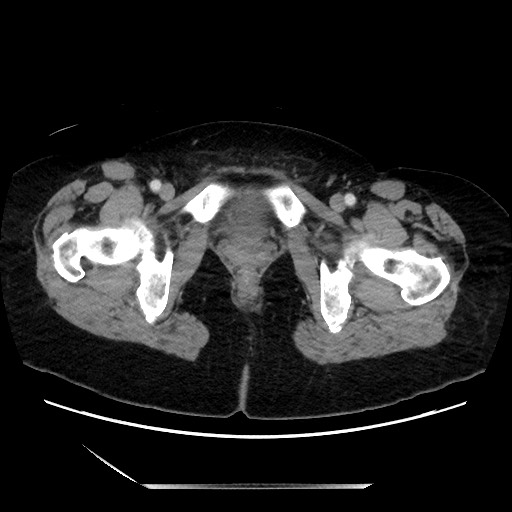 File:Closed loop small bowel obstruction due to adhesive bands - early and late images (Radiopaedia 83830-99014 A 157).jpg
