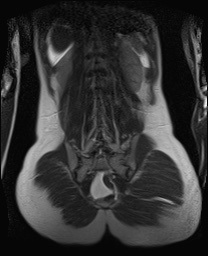 File:Closed loop small bowel obstruction in pregnancy (MRI) (Radiopaedia 87637-104031 Coronal T2 45).jpg
