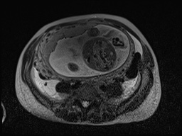 Closed loop small bowel obstruction in pregnancy (MRI) (Radiopaedia 87637-104031 D 13).jpg