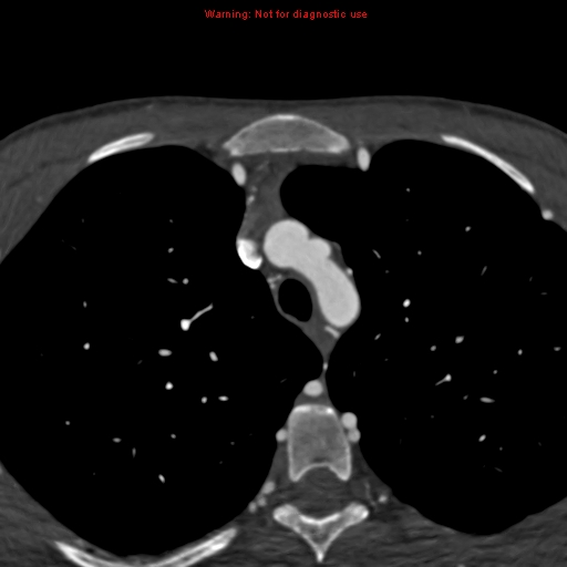 File:Coarctation of the aorta (Radiopaedia 12461-12697 A 34).jpg