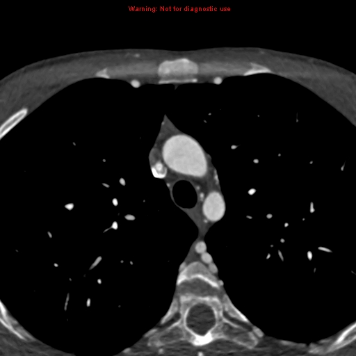 File:Coarctation of the aorta (Radiopaedia 12461-12697 A 76).jpg