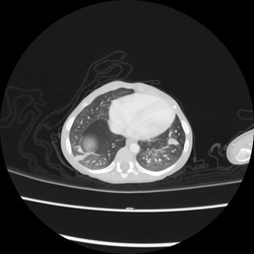 Coarctation of the aorta and patent ductus arteriosus (Radiopaedia 68033-77499 Axial lung window 48).jpg