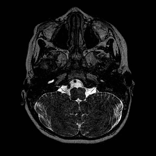 File:Cochlear nerve aplasia - unilateral (Radiopaedia 87910-104413 Axial T2 8).jpg