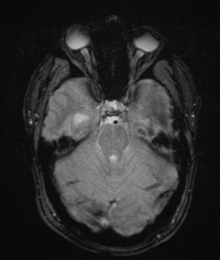 File:Colloid cyst (Radiopaedia 44510-48181 Axial Gradient Echo 9).png