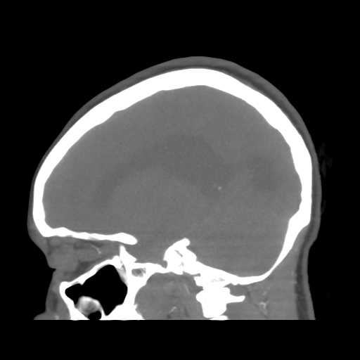 File:Colloid cyst (resulting in death) (Radiopaedia 33423-34499 B 21).png