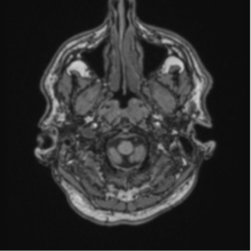 File:Colloid cyst of the third ventricle (Radiopaedia 86571-102662 Axial T1 10).png