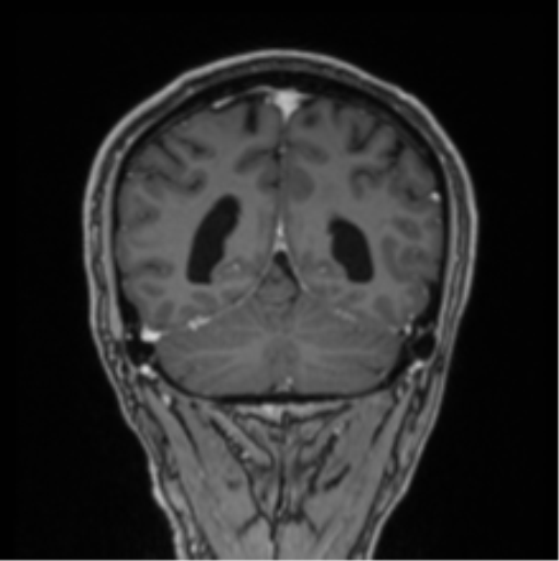File:Colloid cyst of the third ventricle (Radiopaedia 86571-102662 Coronal T1 C+ 26).png