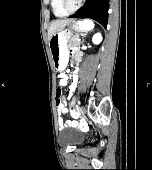 Colon adenocarcinoma - hepatic flexure (Radiopaedia 85635-101395 D 58).jpg